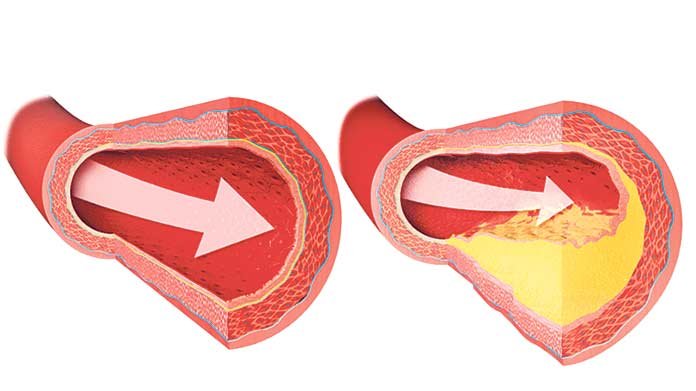 Cholesterol-&-Triglycerides